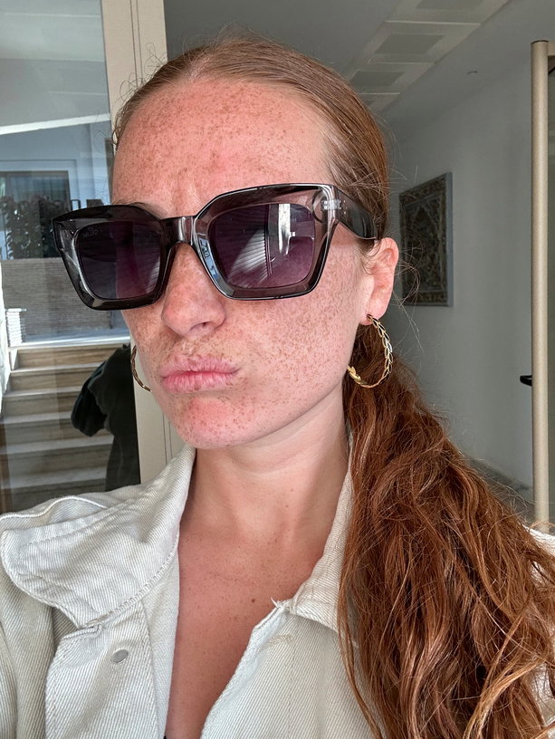 Woman with hyperpigmentation
