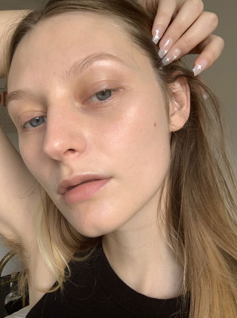 Model Laura Chova after treating her rosacea