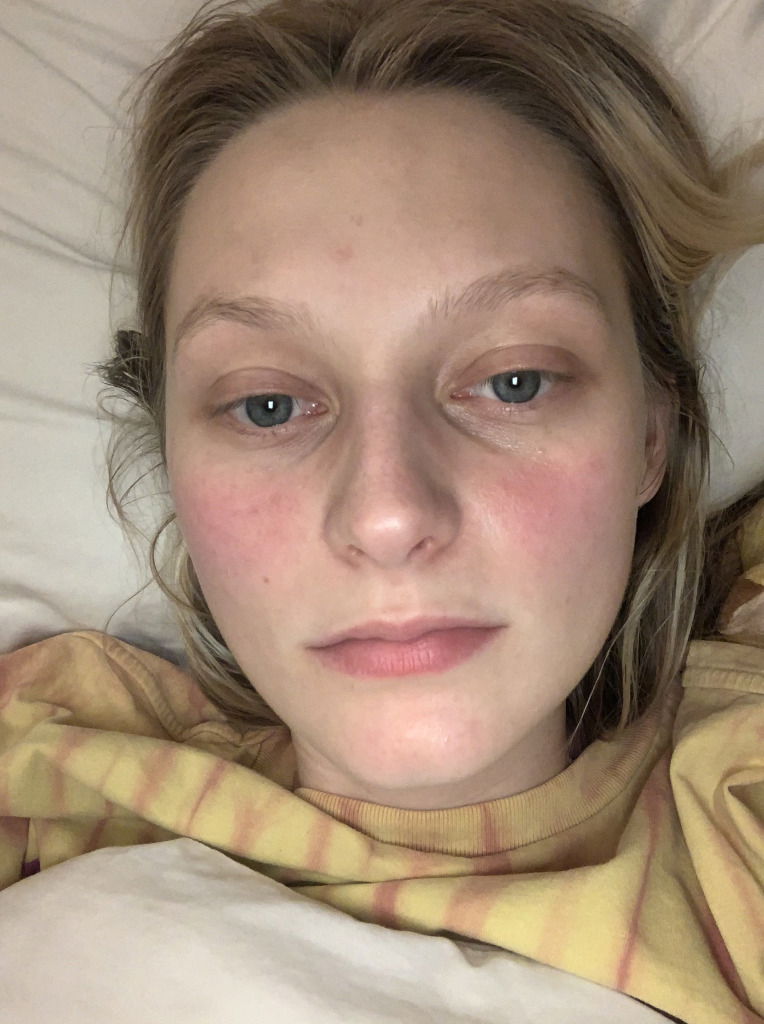 Model Laura Chova while dealing with facial rosacea