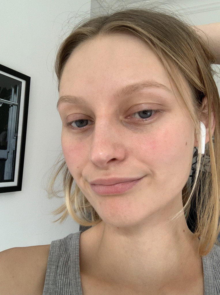 Model Laura Chova with mild rosacea