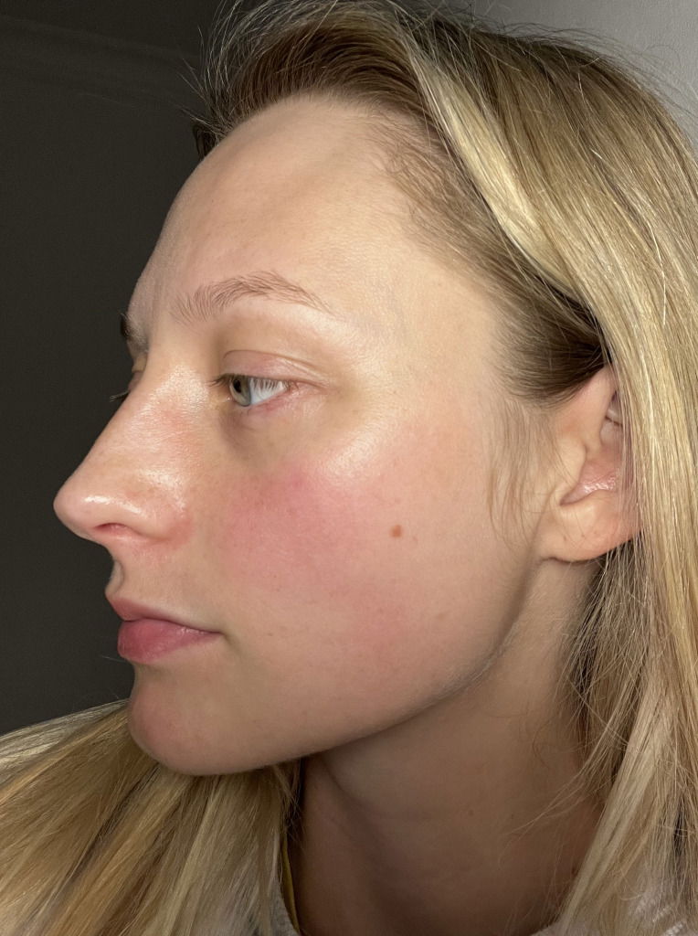 Model Laura Chova as she begins to treat her rosacea