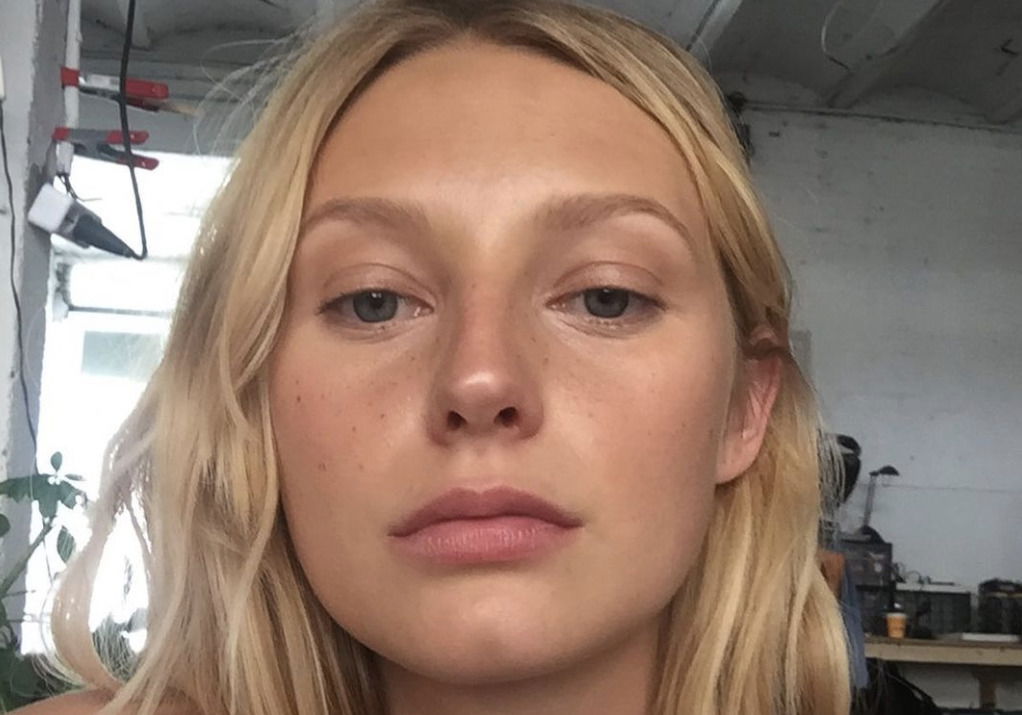 Model Laura D'Chova with clear skin after her journey with rosacea