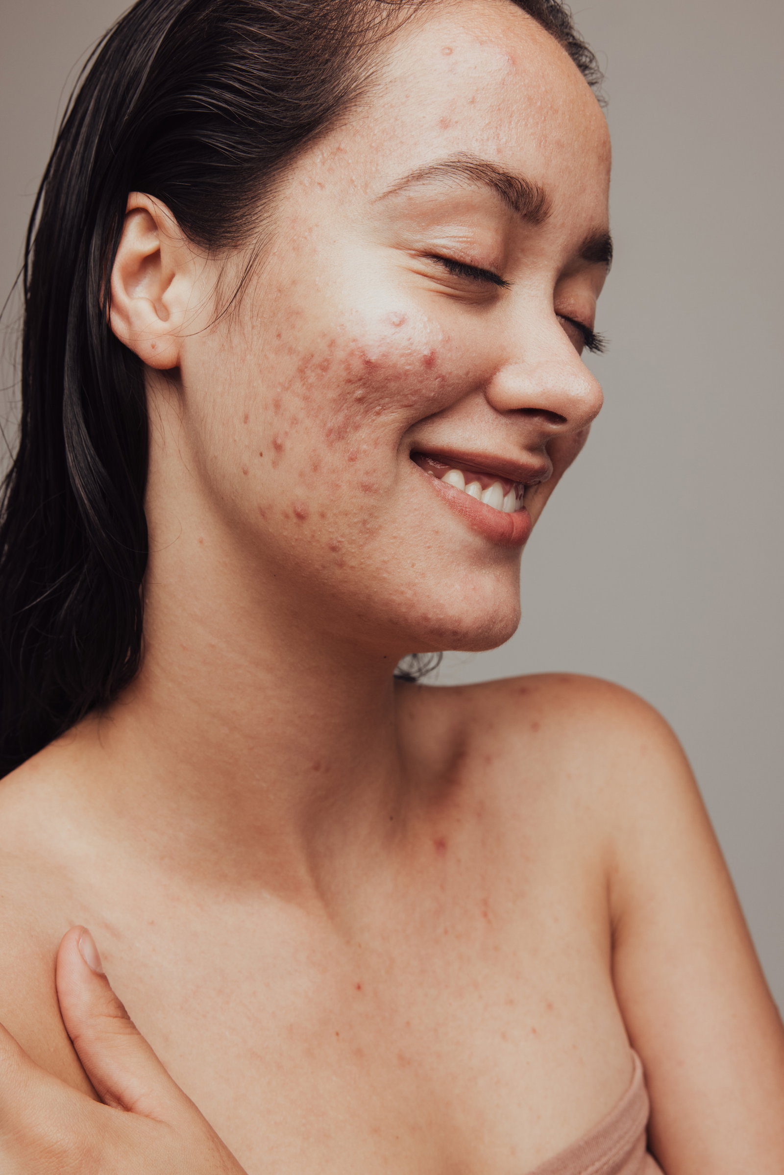 Close up of smiling woman having acne and pimples on face. Young woman smiling with eyes closed despite skin problems. | Live That Glow