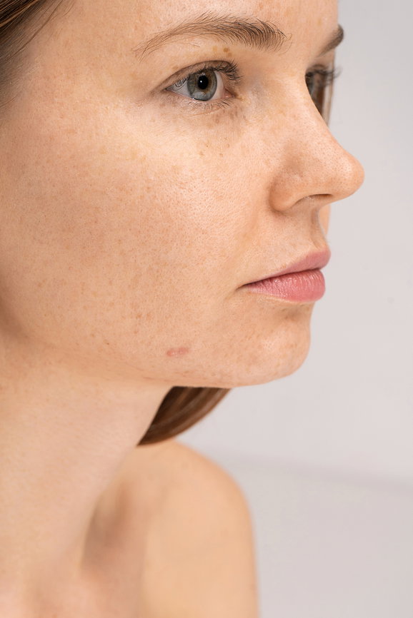 Close-up portrait of young woman with problem skin and freckles on face in studio