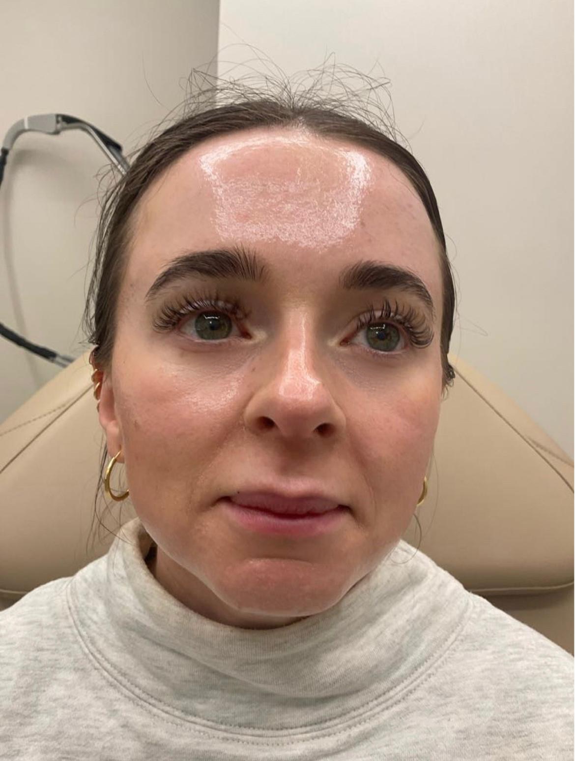 Journalist Grace Day before her HydraFacial
