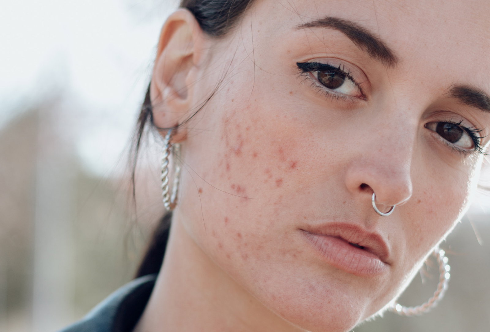 acne skin