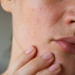 pores perioral dermatitis