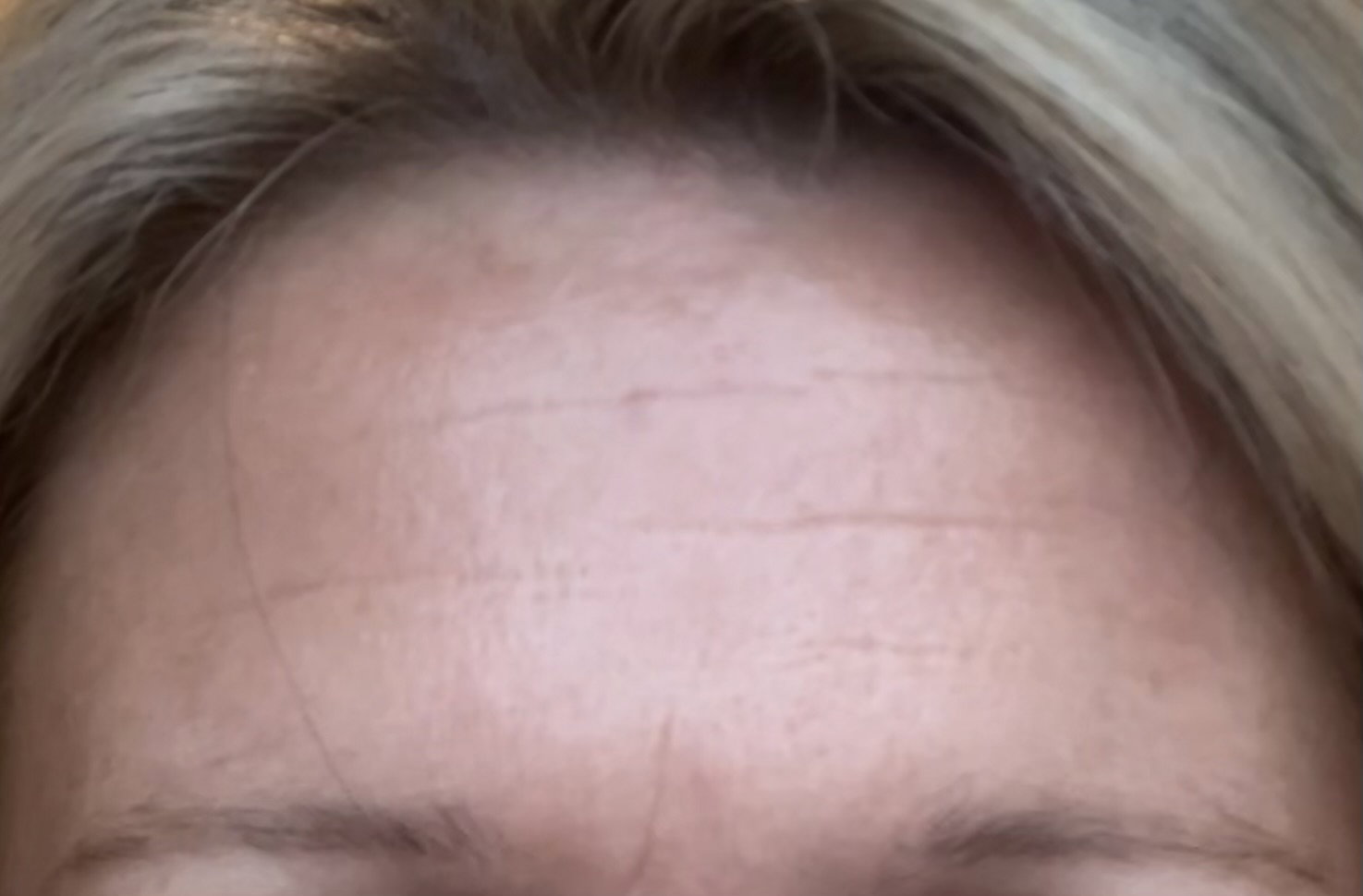 Ole forehead AFTER
