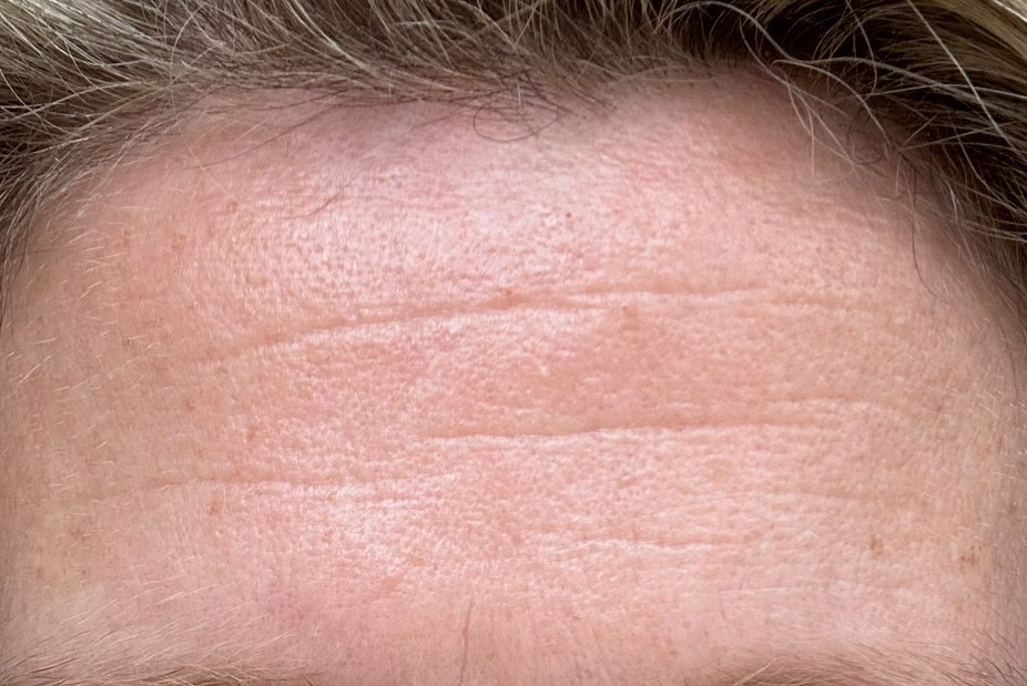 Ole forehead BEFORE