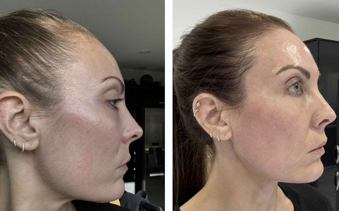Hair growth results of a woman before and after using CurrentBody's LED Hair Growth Helmet