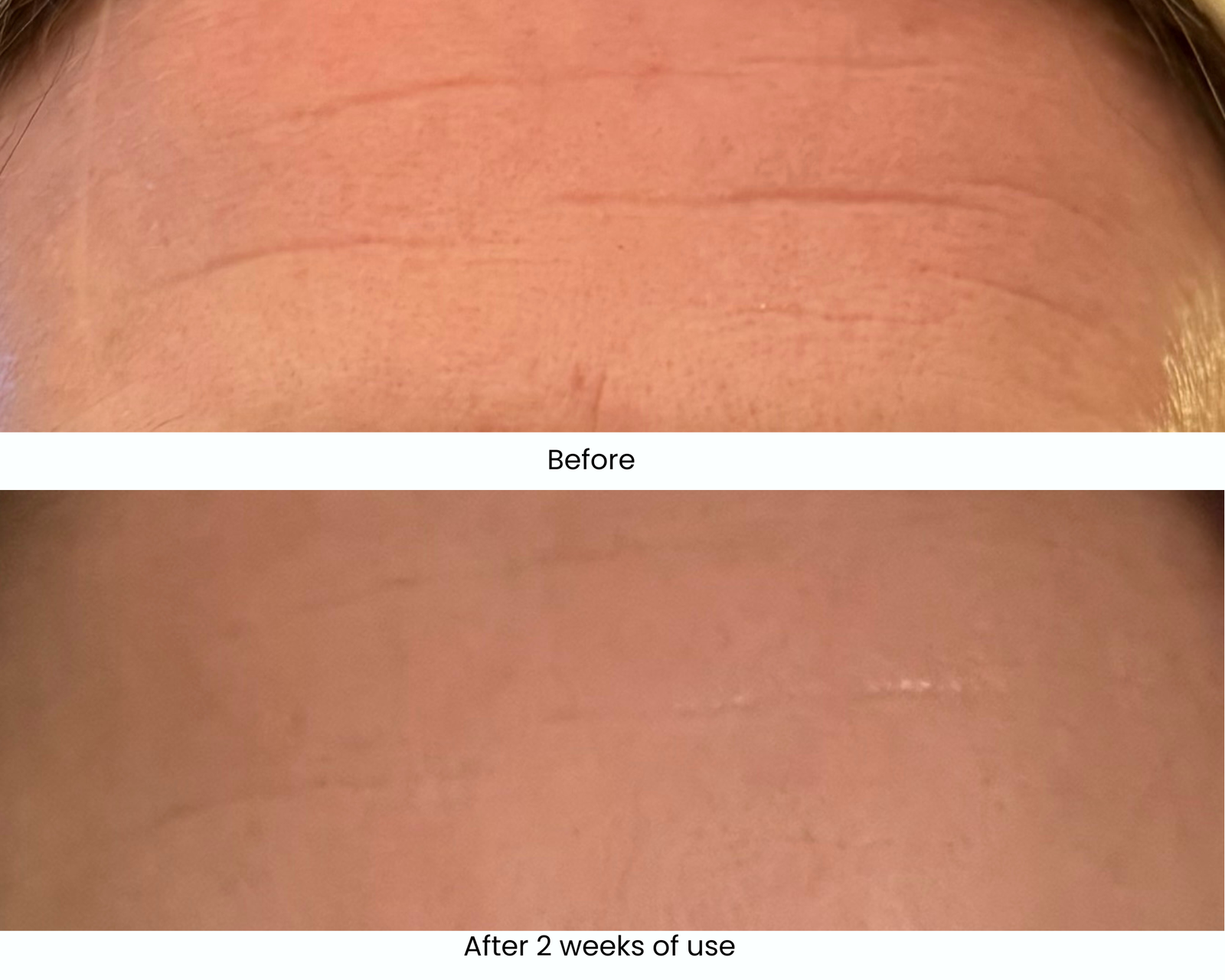 Before and after using Lumalux LED mask | Live That Glow Before and after using Lumalux LED mask