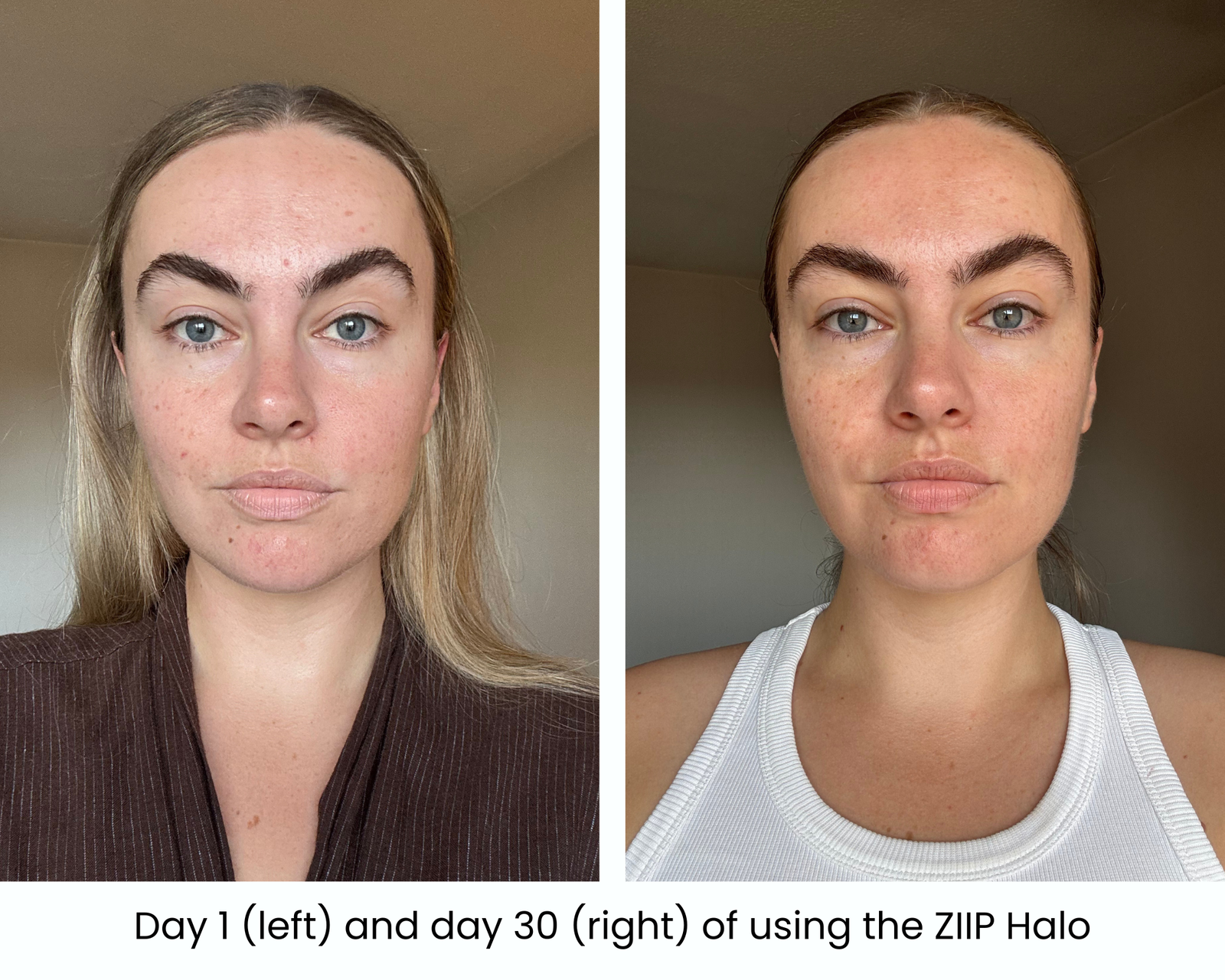 Before and after comparison showing the writer's skin on day 1 and day 30 of using the ZIIP Halo microcurrent facial device.